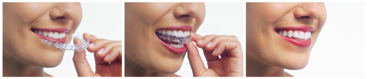 Woman Placing Invisalign Tray Illustration