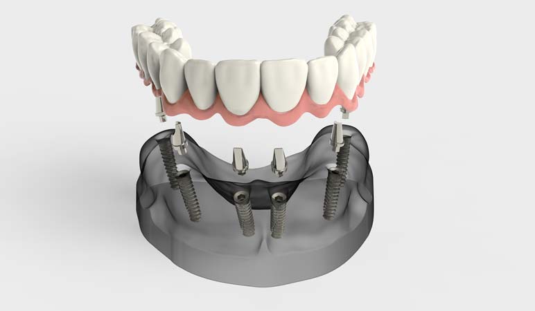 All on 4 Dental Implant Illustration & Composition