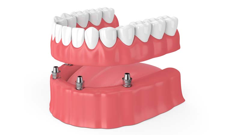All on 4 Dental Implants All on 4 Dental Implants