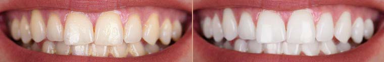 Teeth Whitening Before After