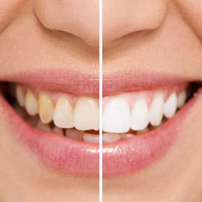 Dental Tooth Bonding Before & After