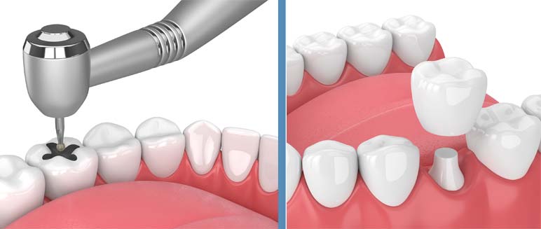 The Dental Crown Procedure