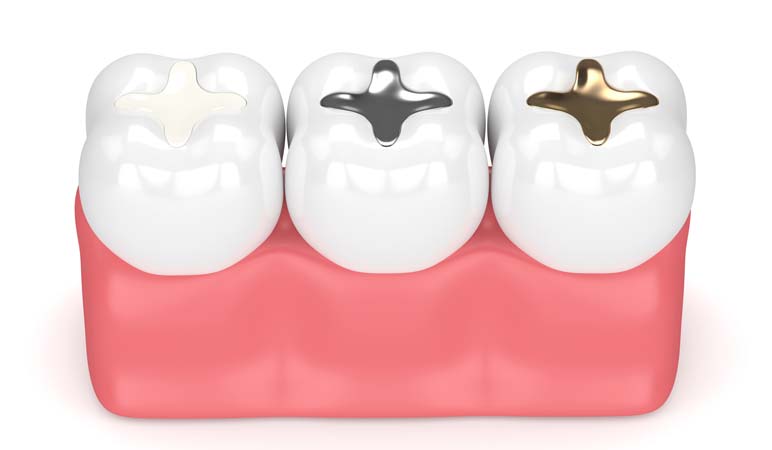 Types of Dental Fillings