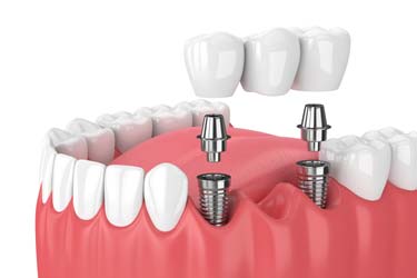 Implant Supported Dental Bridge