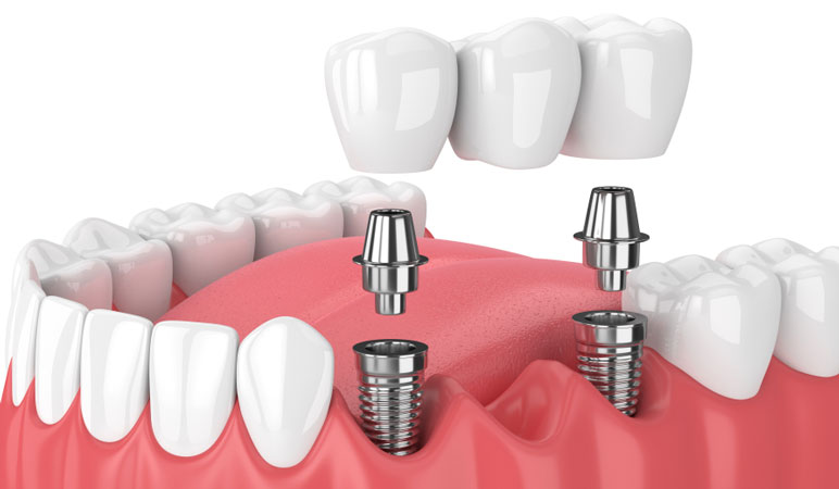 Implant Dental Bridge