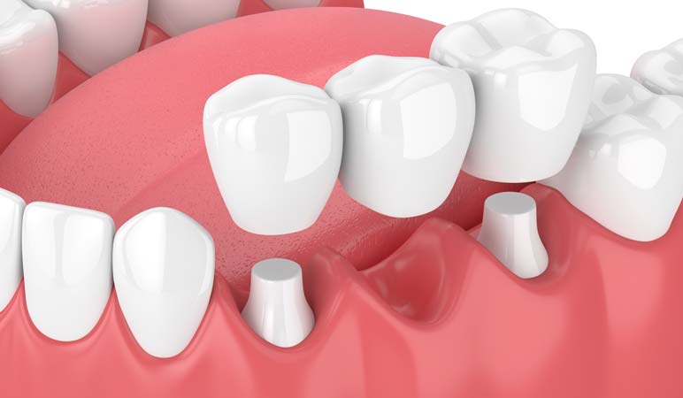 Multiple Tooth Dental Bridge