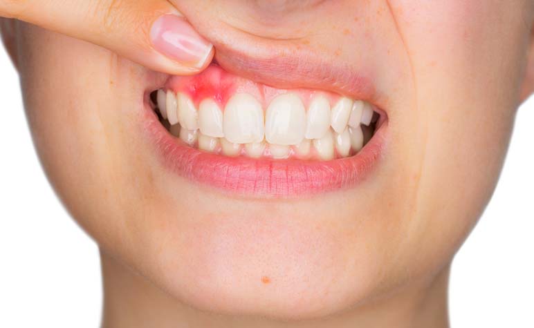 Woman with Redness on Gums