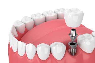 Single Tooth Replacement - Dental Implant