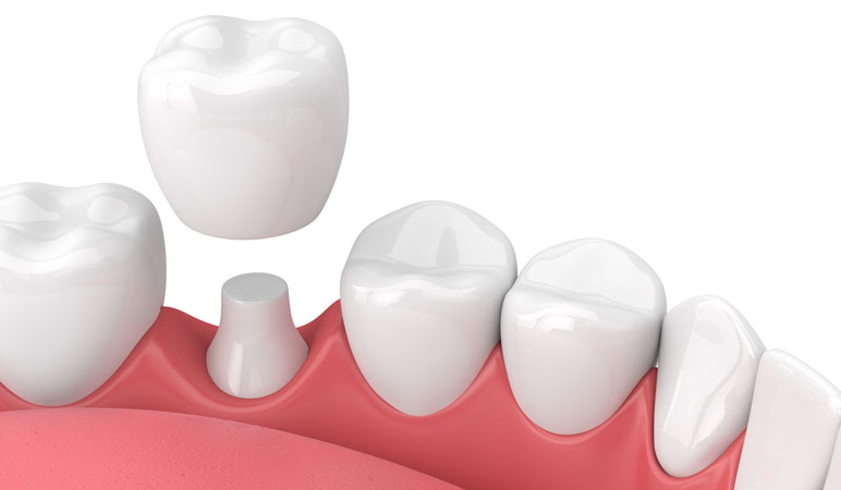 Single Tooth Colored Dental Crown