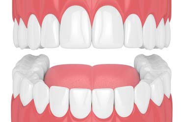 Teeth Impressions
