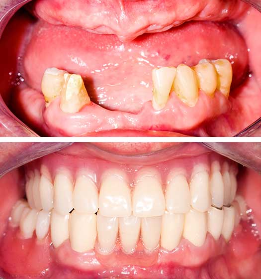 Full Mouth Implant Before After