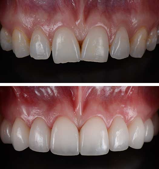 Dental Crowns Top Teeth Before After