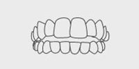 Open Bite Illustration