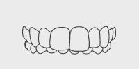 Overbite Illustration